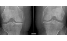 Ostéonécrose spontanée du condyle interne