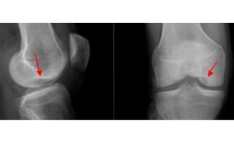 Ostéochodrite disséquante des condyles fémoraux