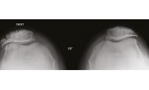 Rotule bipartite, dysplasie et arthrose fémoro-patellaire