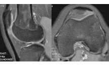 Syndrome de friction entre le ligament patellaire et le condyle latéral