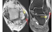 Luxation des tendons fibulaires