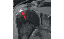 Rupture non transfixiante de la face articulaire du tendon du supra-épineux