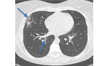 Pneumopathie en rapport avec la COVID-19