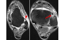 Rupture du ligament tibio-fibulaire antérieur