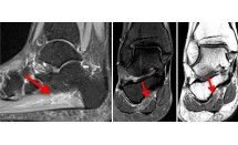 Thrombose de la veine plantaire latérale