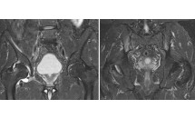 Arthrite de hanche dans le cadre d'une spondylarthropathie