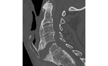 Fracture sur hyperostose vertébrale ankylosante