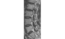 Dépôt de cristaux d'hydroxyapatite dans le foramen L2-L3 droit