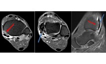 Fissure longitudinale du tendon tibial postérieur ostéochondrome de la malléole médiale