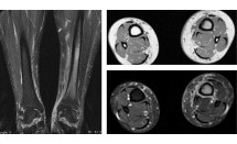 Fracture de fatigue du tibia