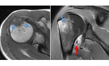 Fracture du trochiter et lésion capsulaire de type «HAGL»