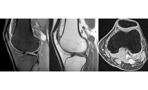 Schwannome du nerf tibial